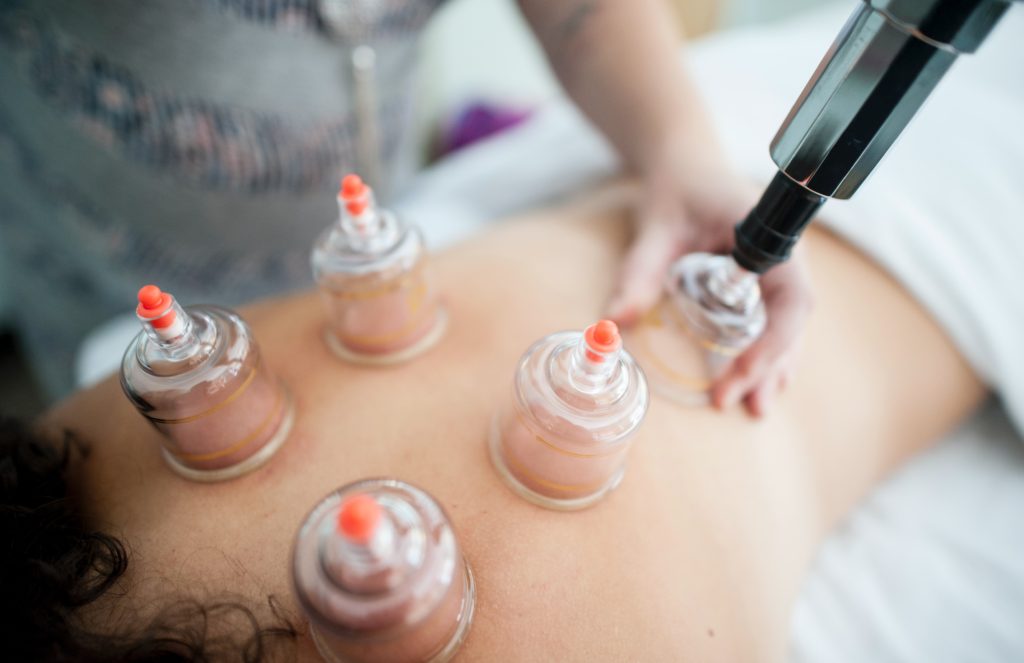Cupping Therapy Uses Benefits And Side Effects Sti Physical Therapy